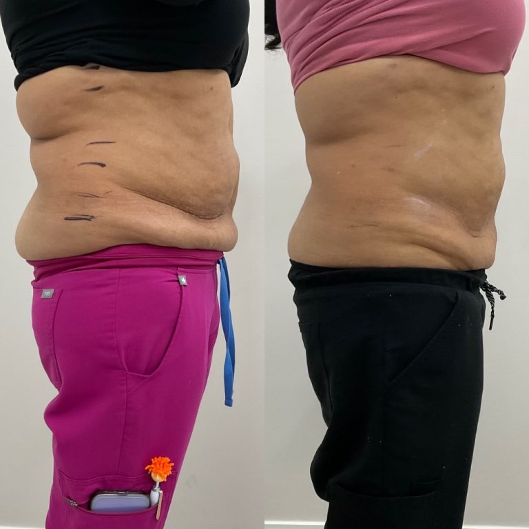 images of belly fats